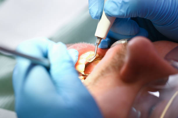 Best Emergency Root Canal Therapy in Red Wing, MN